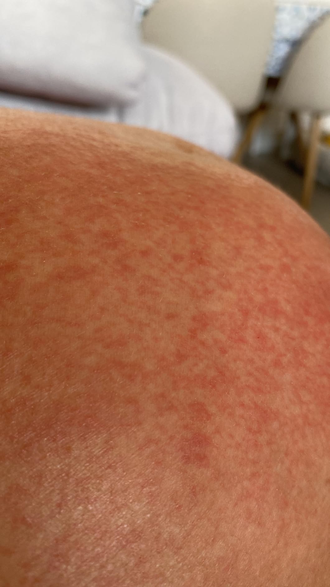 Mejor crema antiestrías que he probado